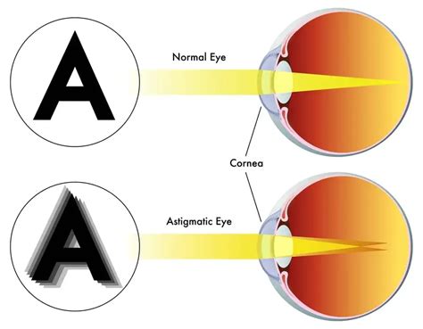 Symptoms of Astigmatism - Heffington's