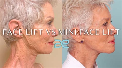 Mini Facelift Marina Del Rey | Mini Facelift Santa Monica