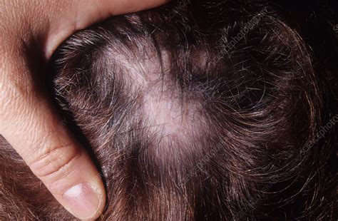 Hair loss from lupus - Stock Image - C046/5397 - Science Photo Library