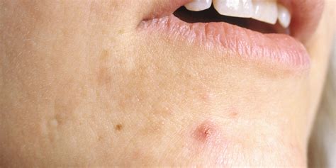 Everything You Ever Wanted To Know About Cystic Acne | HuffPost