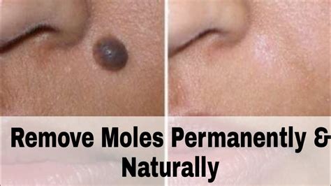 How To Reduce Mole Size - Forcesurgery24