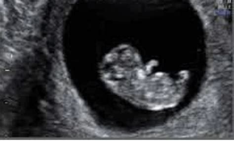 8 Weeks Pregnant Ultrasound of Babies: Heartbeat Display in Action ...