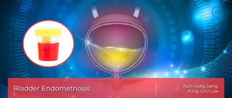 Endometriosis in the Urinary Bladder | EndoNews