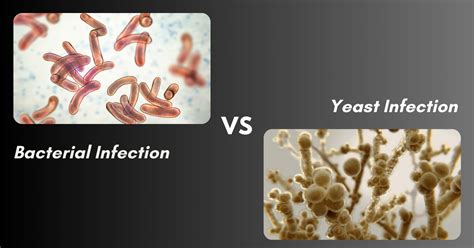 Are Bacterial Infection and Yeast Infection the Same? | Sri Ramakrishna Hospital