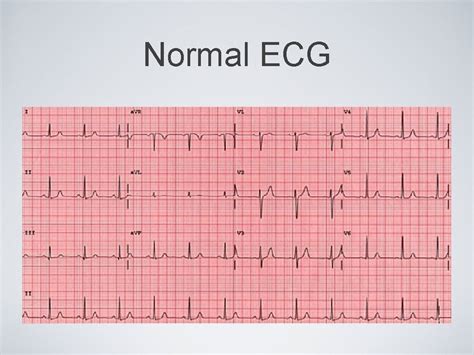 Recognizing Cardiac arrhythmias Normal anatomy Normal ECG Normal