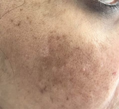 Hyperpigmentation | Pigmentation treatment London | Melasma