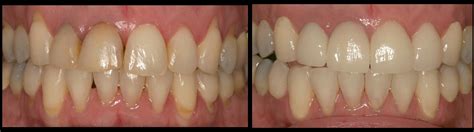 Has anyone had success remineralizing their teeth with Recaldent (aka MI Paste)?