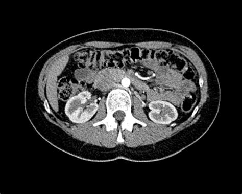 What is a Kidney CT scan? | Two Views