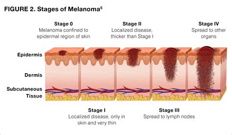 Melanoma Skin Cancer Metastasis