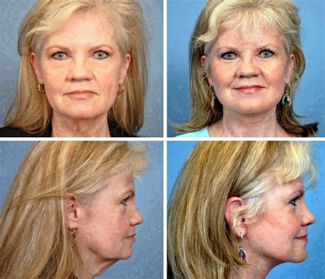 Facelift Lower Face Lift Photos Before And After » Facelift: Info, Prices, Photos, Reviews, Q&A