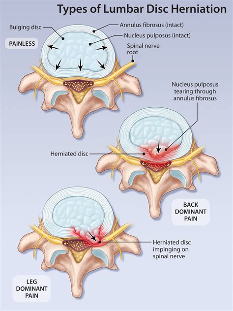 Herniated Disc Treatment