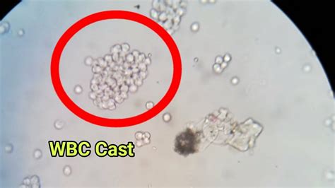 Wbc Casts In Urine