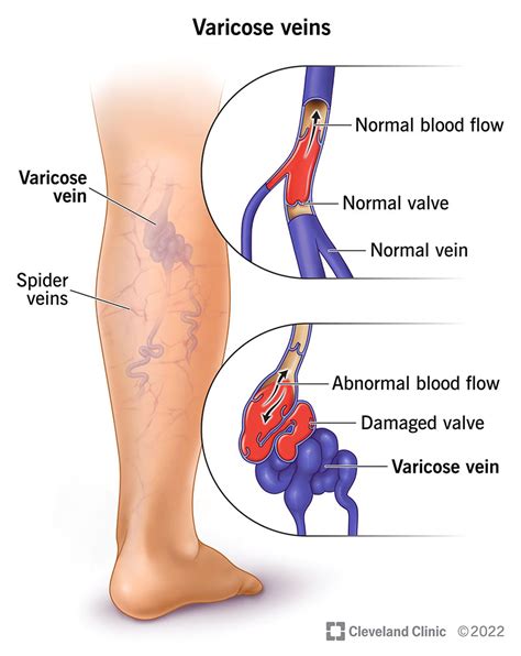 Varicose Veins: Causes & Treatment