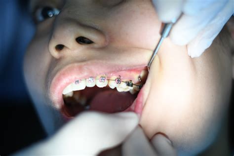 Do Braces Hurt? – Lancaster Dental Texas