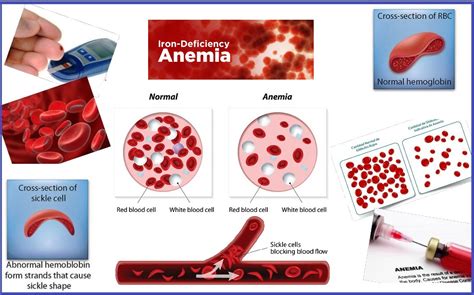 Treatment for Anemia | Homeopathic Medicine for Anemia Treatment