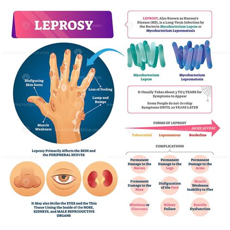 Leprosy vector illustration - VectorMine