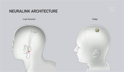 Breaking Ground: Elon Musk Reveals Successful Implantation of Neuralink Wireless Brain Chip | by ...