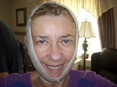 Smas Facelift Recovery Photo (7) » Facelift: Info, Prices, Photos, Reviews, Q&A