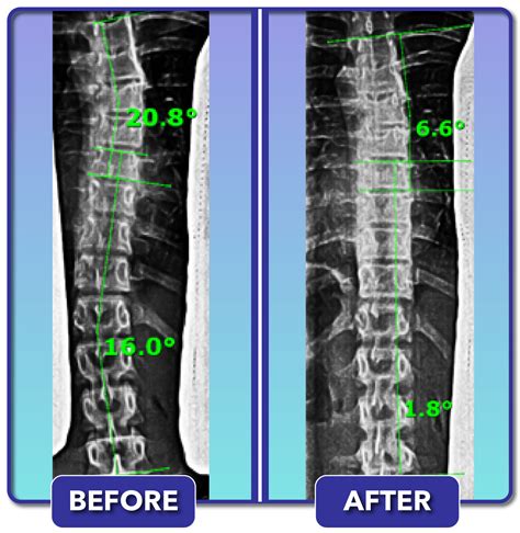 Scoliosis Before and After Treatment Results - Scoliosis Care Centers