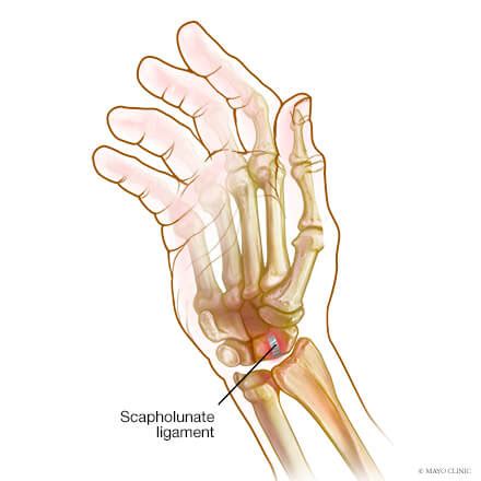 Wrist sprains - Overview - Mayo Clinic Orthopedics & Sports Medicine