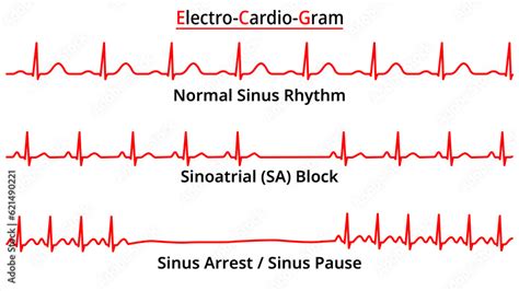 Set of ECG Common Abnormalities - Sinoatrial (SA) Block - Sinus Arrest ...