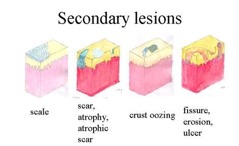 Skin Lesions Types