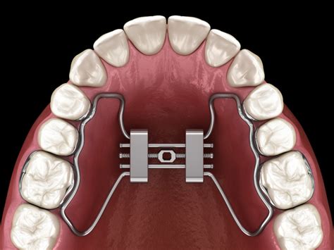 Ways To Treat A Misaligned Jaw | Ahava Orthodontics