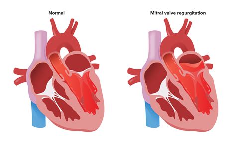 Pulmonary Valve Regurgitation