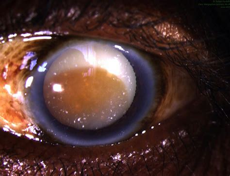 cataract – Tropical Ophthalmology