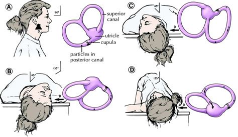 Epley Maneuver Right Ear