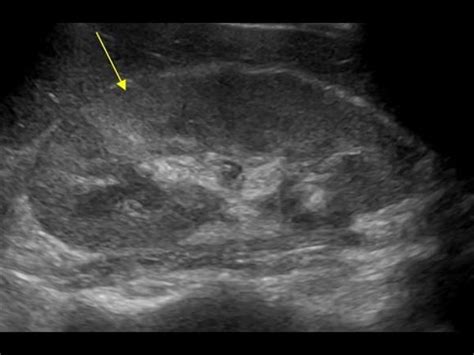 Longitudinal focal pyelonephritis with decreased vascularity | Ultrasound, Sonography ...