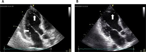 Deciphering Post-STEMI Complications: LV Thrombus vs. Intra-Myocardial Dissection Hematoma