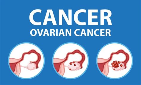 Premium Vector | Illustrated infographic of woman39s ovarian cancer stages