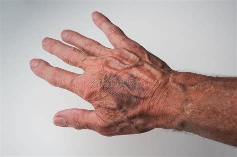 Bruises and Blood Spots Under the Skin that Occur on Older People Stock ...