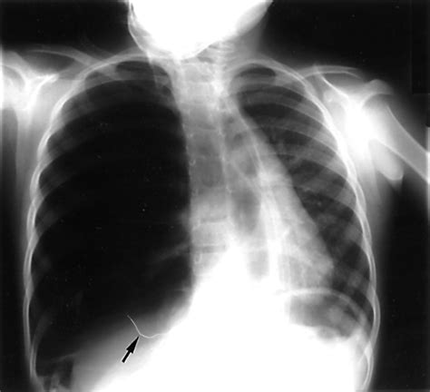 Tracheal Deviation Tension Pneumothorax