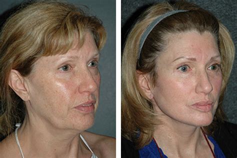 Lower Facelift New York | Lower Facelift and Necklift