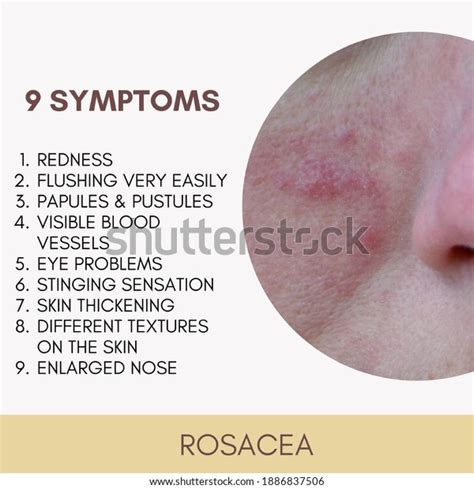 Common Rosacea Symptoms Skin Disease Chronic Stock Photo 1886837506 ...