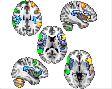 Genetic Variants Link Left-Handedness with Brain Architecture and Psychiatric Disorders