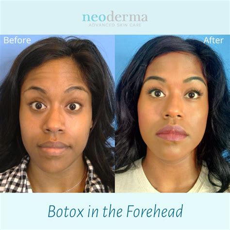 Botox — Neoderma Advanced Skin Care