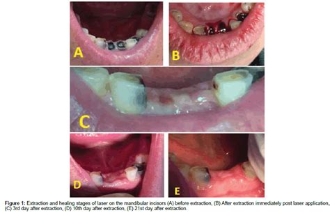 Stages Of Tooth Extraction Healing