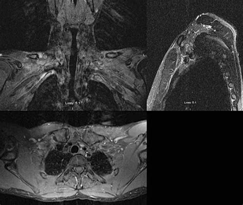 MRI of the left brachial plexus using the Conventional technique, in... | Download Scientific ...