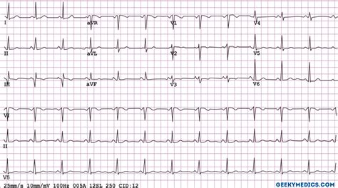 ECG - ECG (disambiguation) - JapaneseClass.jp