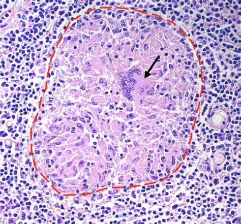 Tuberculosis Granuloma