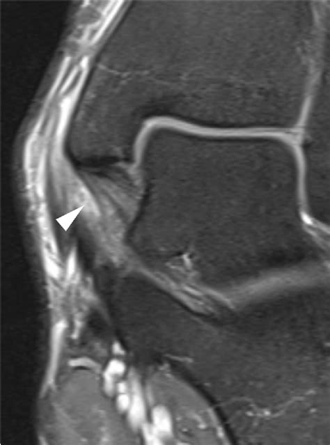 Deltoid Ligament Mri