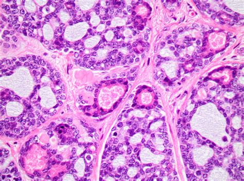 Adenoid Histology