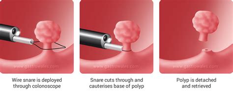 Colonoscopy With Polypectomy Procedure Overview Using, 53% OFF