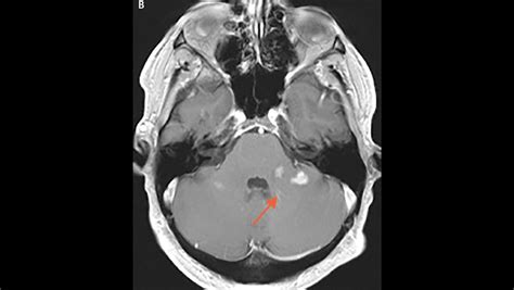 Optic Nerve Lesions - The Neurology Hub