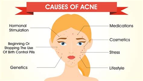 Causes of Acne: Why Do You Get It & How You Can Prevent It