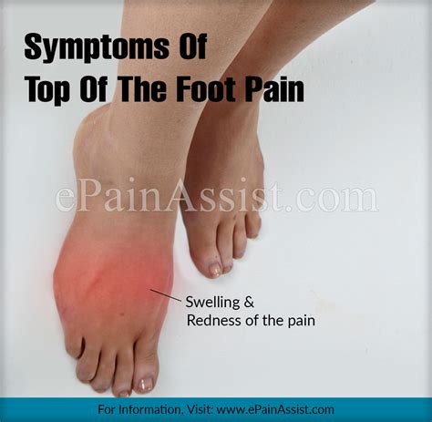 Foot Pain Location Diagram Image