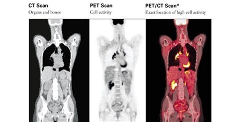 PET/CT Scan | University Radiology Associates, LLP | SUNY Upstate Medical University